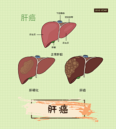 肝癌 人体消化系统肿瘤癌症细胞疾病症状医疗人体系统 人体解剖 人体
