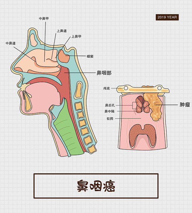 鼻咽癌人体呼吸系统肿瘤癌症细胞疾病症状医疗人体系统人体解剖人体