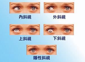 新提醒武汉斜视手术后会复发吗小孩视功能不完善复发率高艾格眼科aige