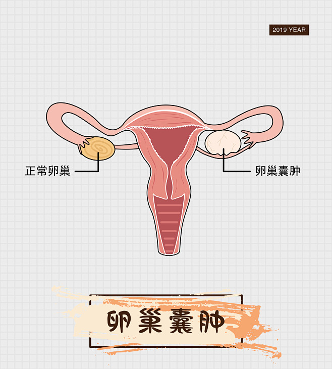 卵巢囊肿人体生殖系统肿瘤癌症细胞疾病症状医疗人体系统人体解剖人体