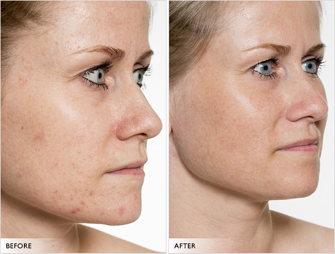 10:03:22before/after - serum038对比/肌肤问题-nnnyy