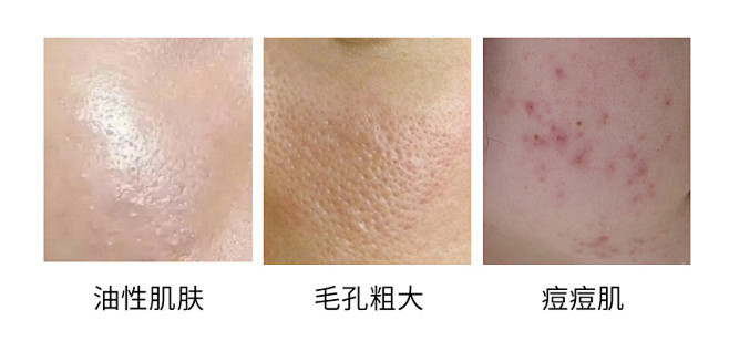 油性肌肤毛孔粗大痘痘肌