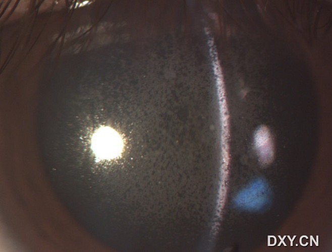 者曾于2004年在外院行PRK手术,当时患者术后