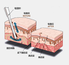 ✎﹏ℳ๓₯㎕梁ω采集到光纤溶脂