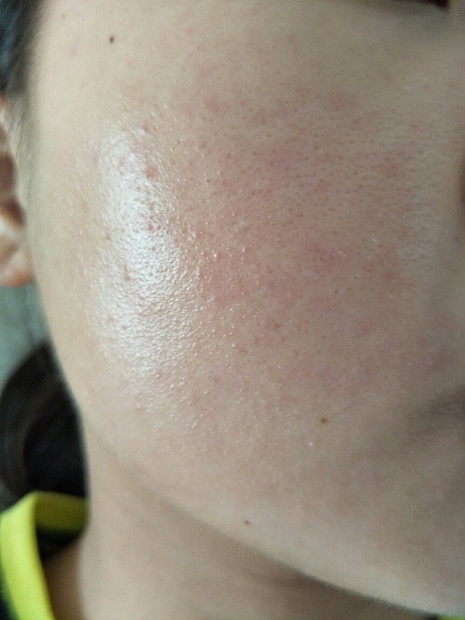 化妆品过敏的脸图片女人脸过敏图片脸上丘疹护肤品脸过敏图片脸部过敏