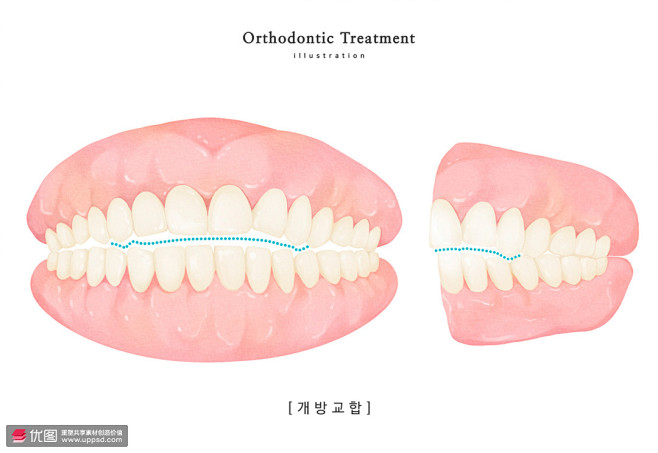 口腔模型 牙齿牙龈 咬合线 健齿插图插画
