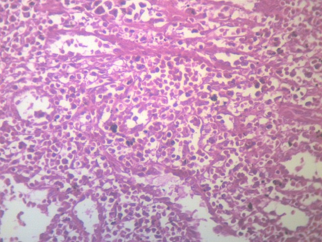 脾被膜玻璃样变显微切片图片