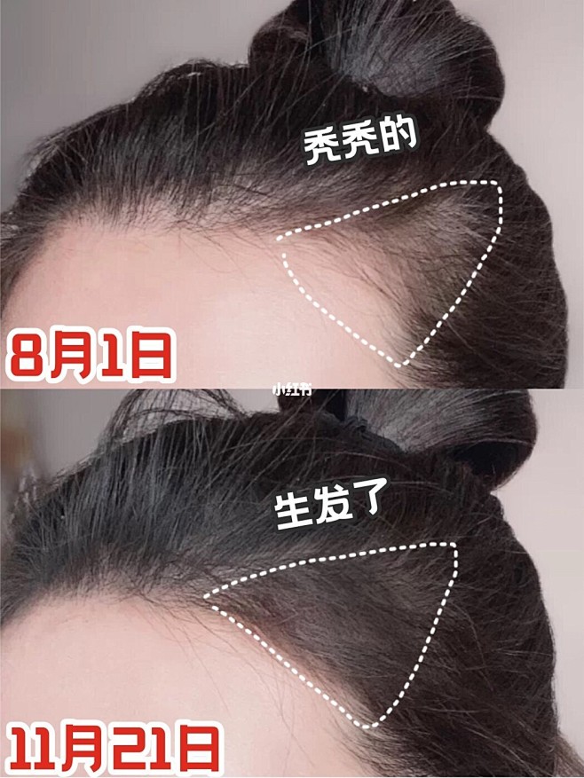 走了不女生鬓角秃的原因头发两边鬓角秃女生两鬓秃的原因女生秃鬓角